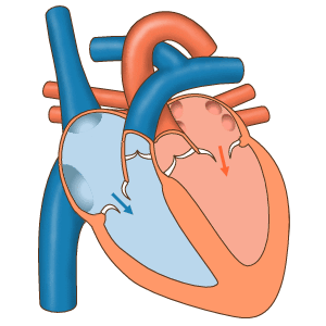 pacemaker