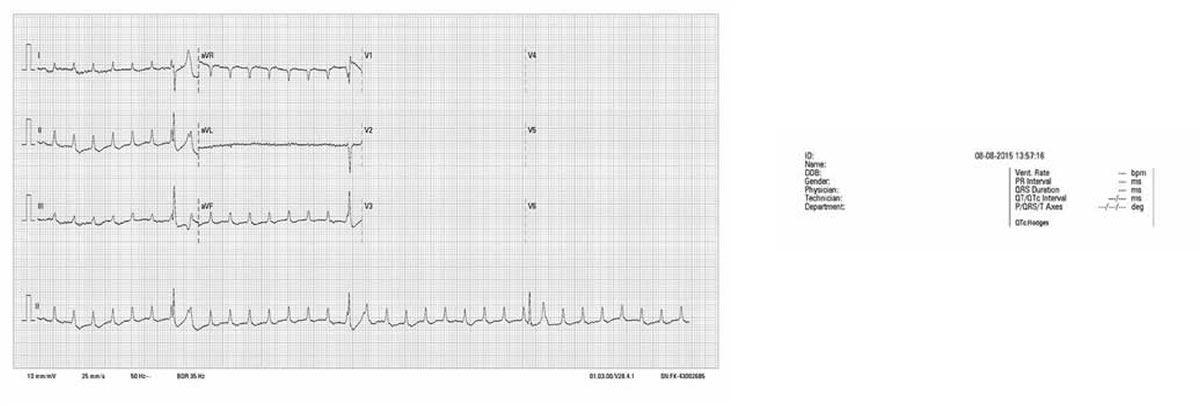 pacemaker
