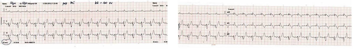 pacemaker