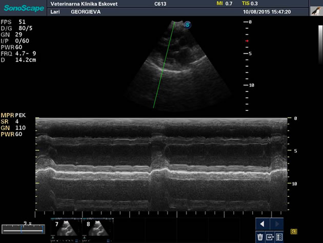 pacemaker
