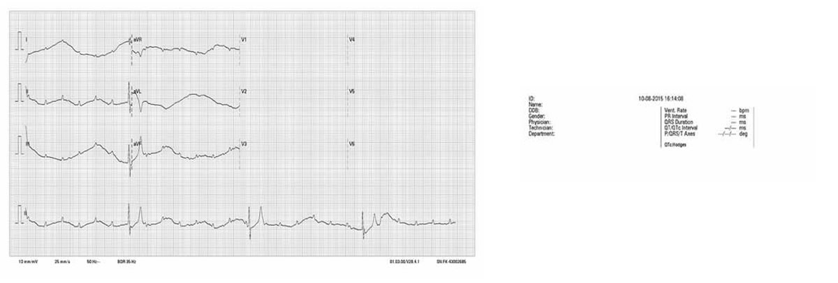 pacemaker